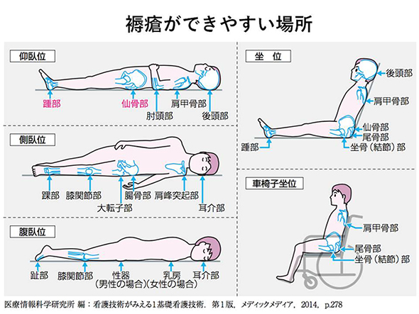 褥瘡ができやすい場所